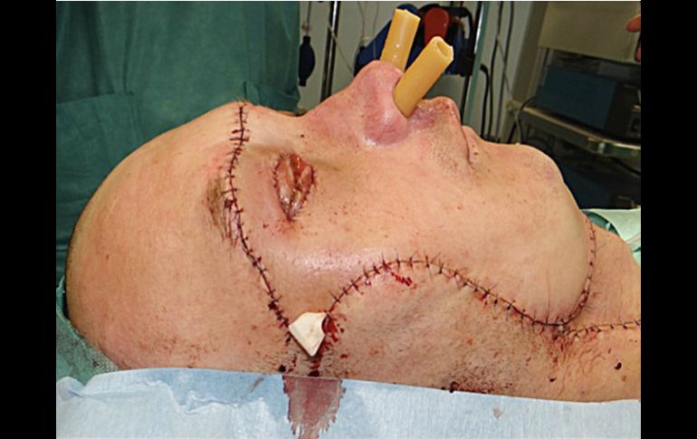 La cirugía reconstruyó el área alrededor de los ojos, la nariz, la mandíbula y el paladar. AP /