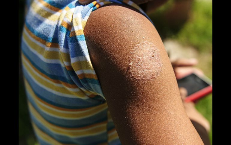 Hasta el 20 por ciento de la población mundial padece dermatitis atópica. EL INFORMADOR / ARCHIVO